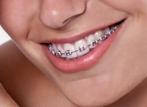 braces